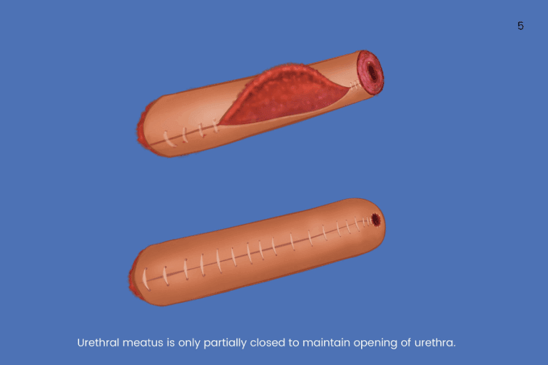 How Is Bottom Surgery Done - Gender Confirmation